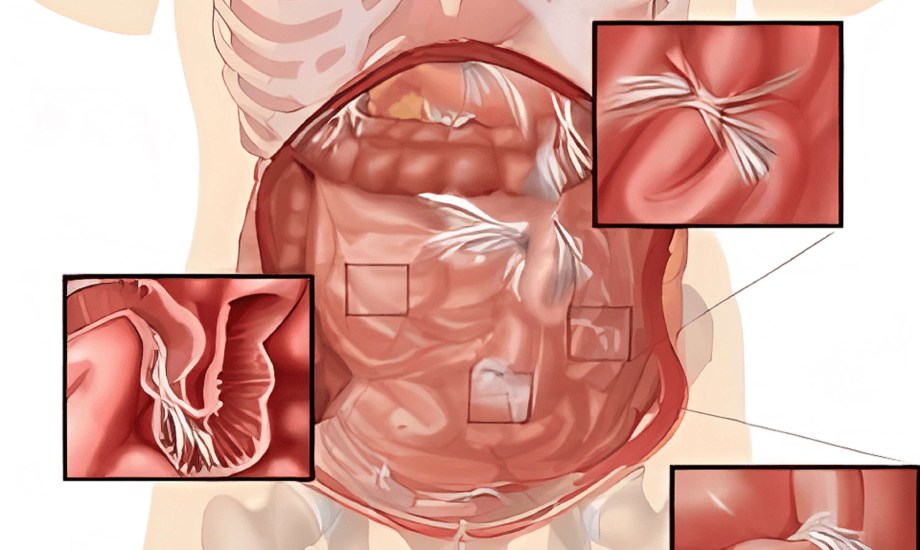 الوقاية من الالتصاقات بعد القيصرية