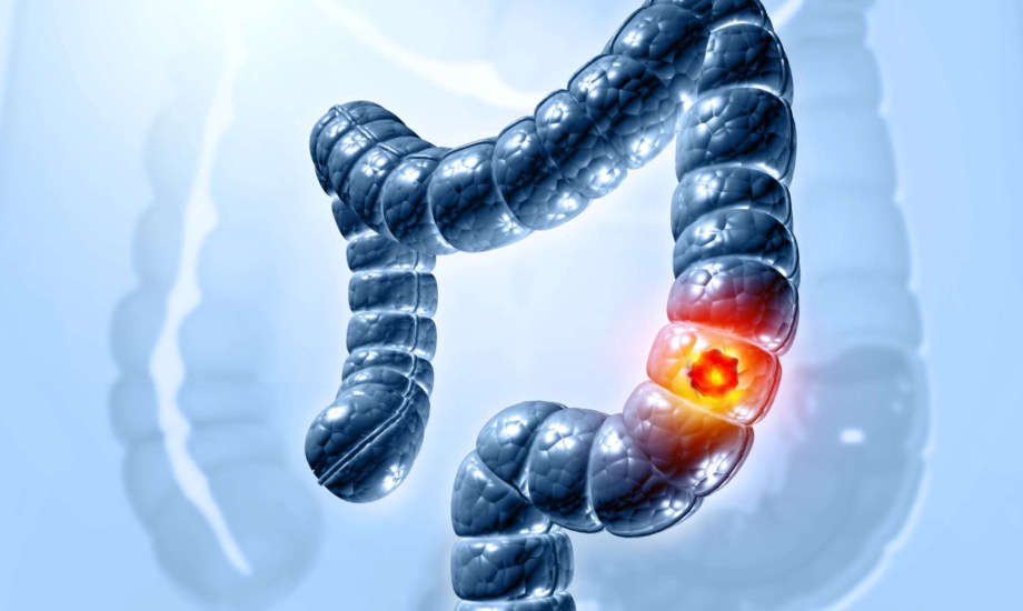 التنبؤ بخطر الإصابة بسرطان القولون والمستقيم