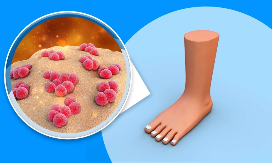 3 طرق للعلاج من داء الفيل ونصائح للوقاية من المرض