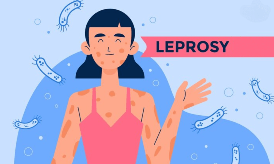 أعراض مرض الجذام وطريقة انتقاله