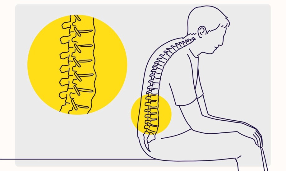 أعراض التهاب الفقار المقسّط وطرق تشخيصه وعلاجه