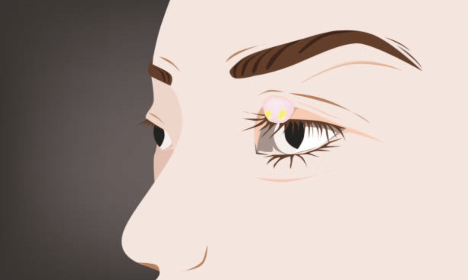 التراخوما.. أسبابها وأعراضها