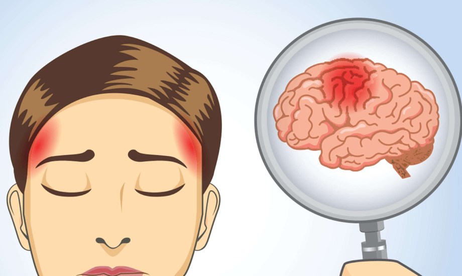 صعقات الدماغ المرتبطة بالتوقف عن مضادات الاكتئاب