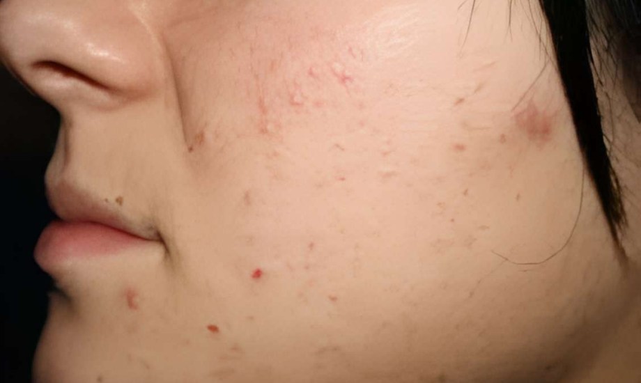 طرق علاج حب الشباب الهرموني