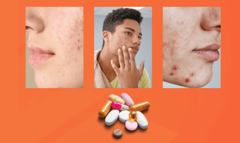 الآثار الجانبية لعقار أيزوتريتينوين والفئات الممنوعة منه