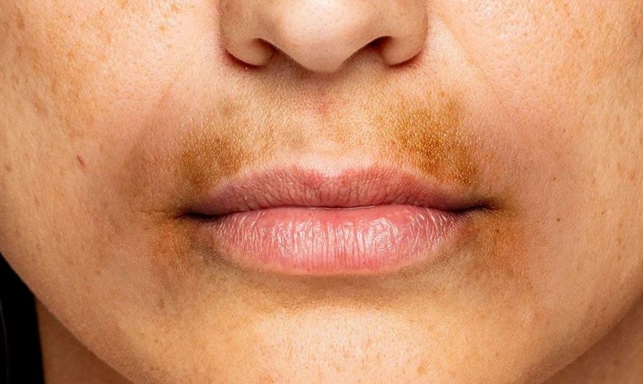 أسباب الاسمرار حول الفم