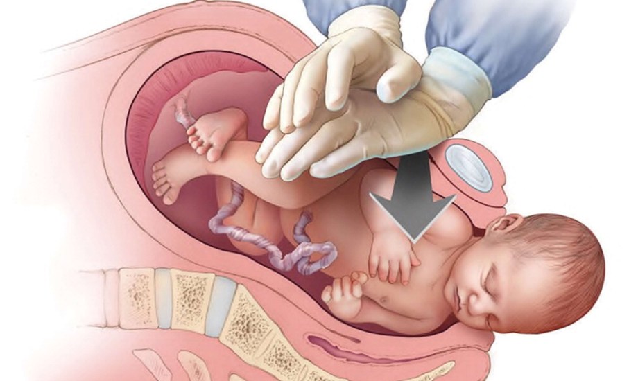 أسباب وأعراض عُسر الولادة الكتفي