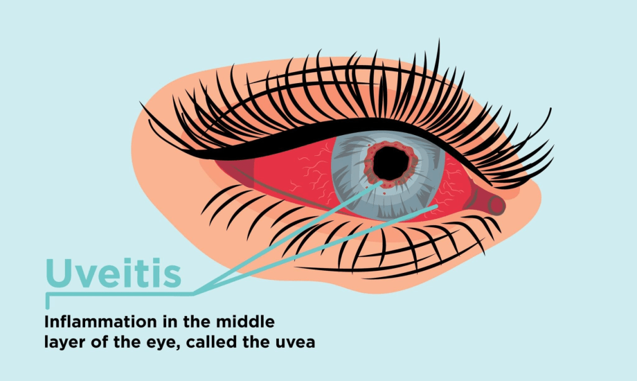 أسباب وأعراض التهاب العنبية 