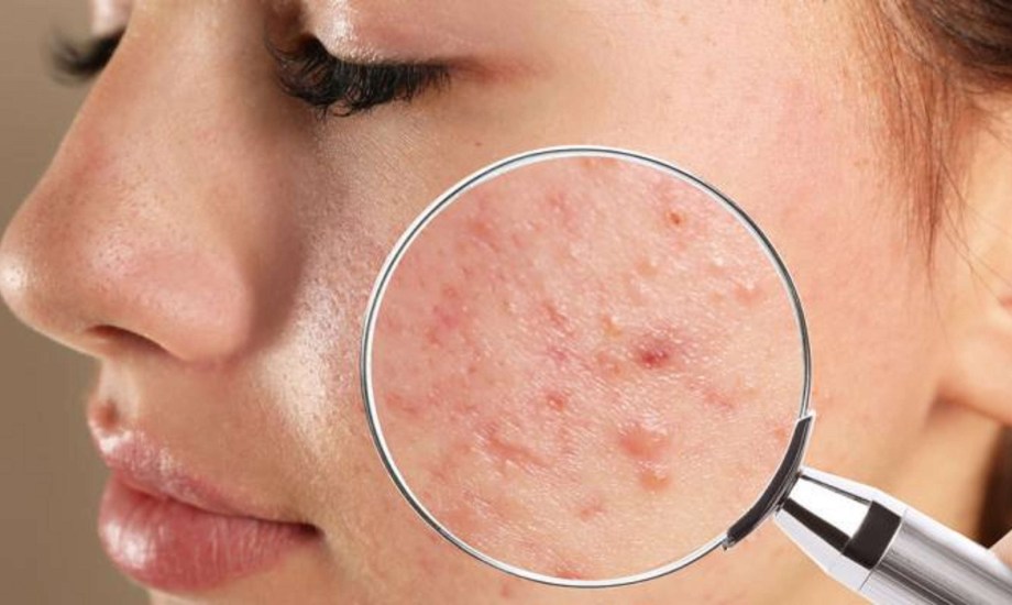 علاج حب الشباب الكيسي
