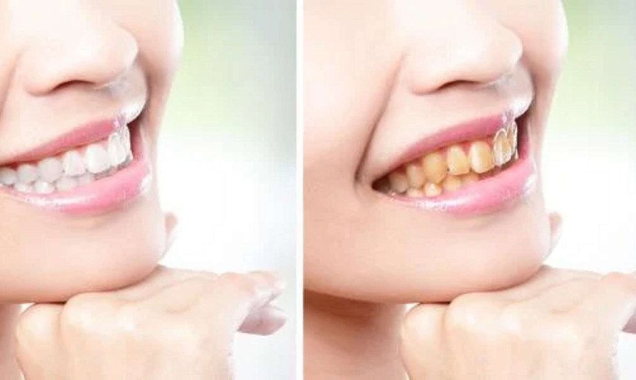 6 علاجات منزلية لاصفرار الأسنان