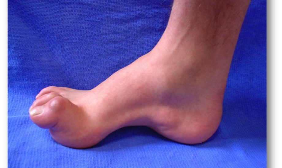 أعراض  داء شاركو ماري توث