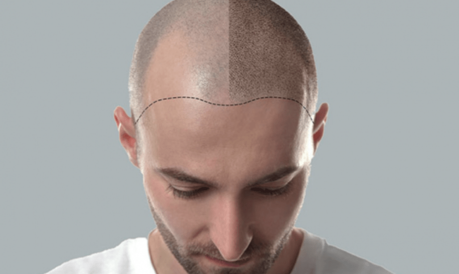 فوائد Microblading hairline طريقة تطبيقها