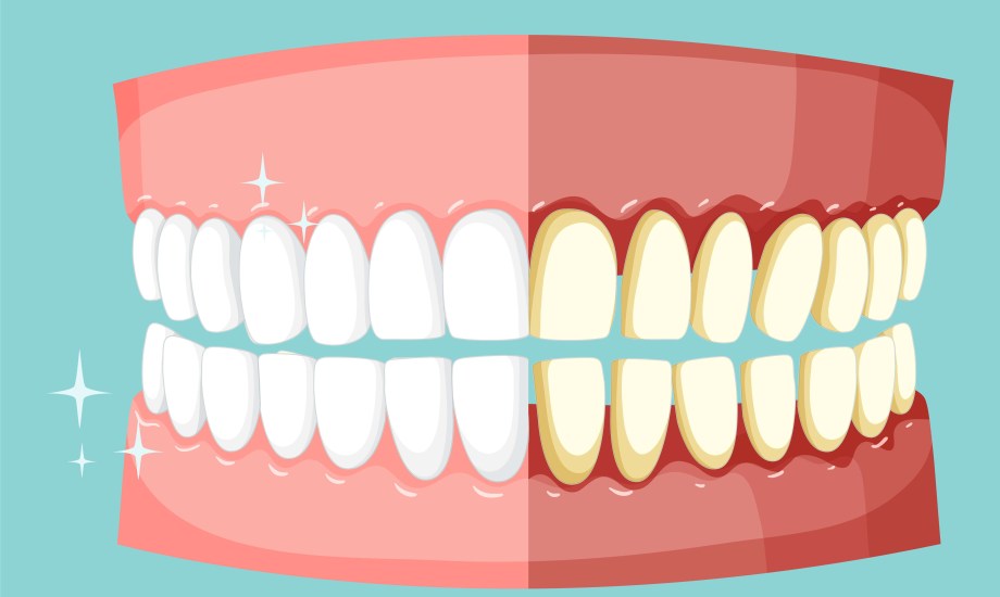 أسباب تغير لون الأسنان