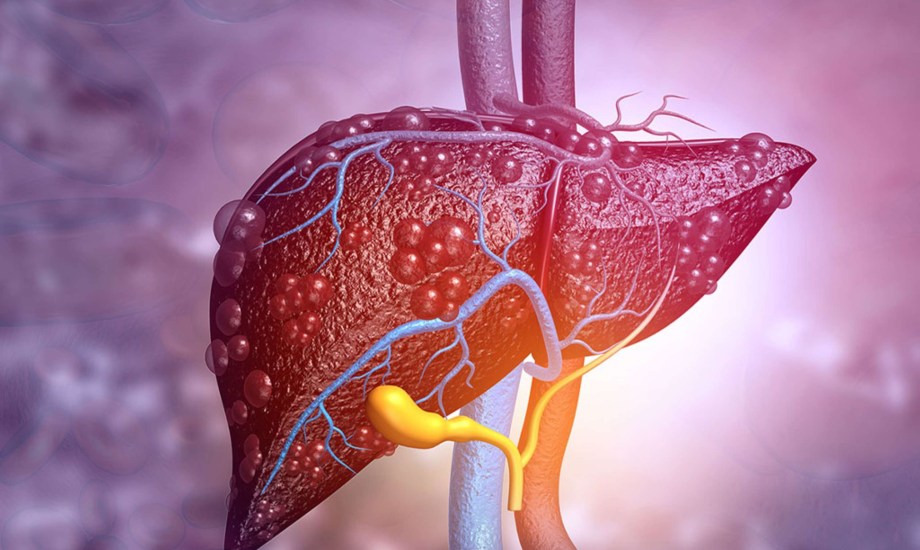 أسباب وأعراض التهاب الكبد الكحولي