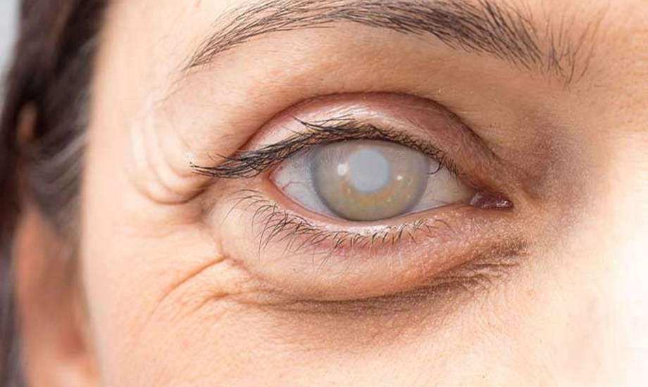 6 فئات أكثر عرضة للإصابة بإعتام عدسة العين الثانوي