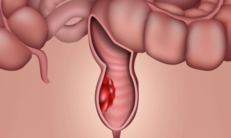 عوامل تزيد خطر الإصابة بسرطان المستقيم