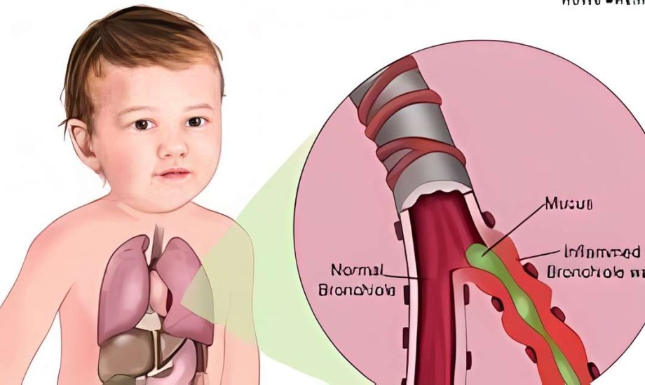 أسباب وطرق علاج التهاب القصيبات الهوائية عند الأطفال