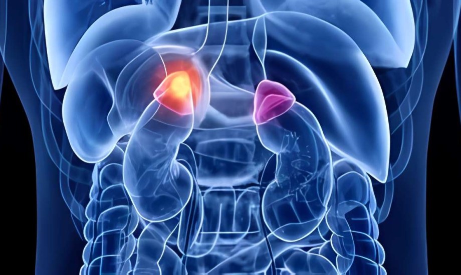 تؤدي أورام الغدة الكظرية إلى الإفراط في إنتاج هرمون الكورتيزول