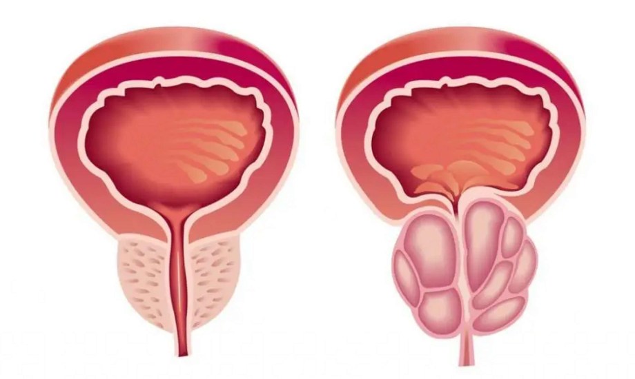 أسباب وأعراض التهاب البروستاتا المزمن