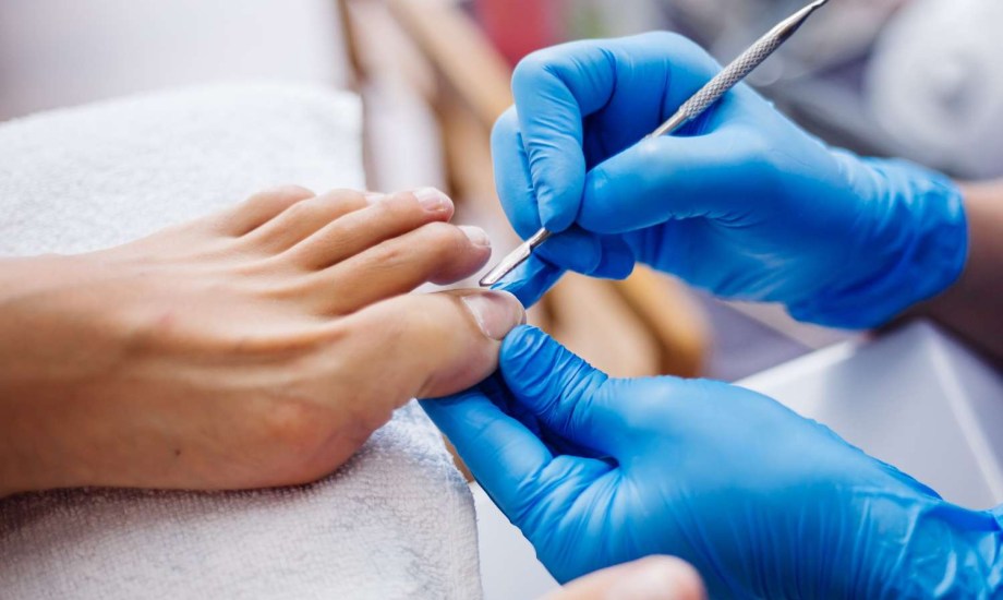 بيروكسيد الهيدروجين لعلاج فطريات أظافر القدم