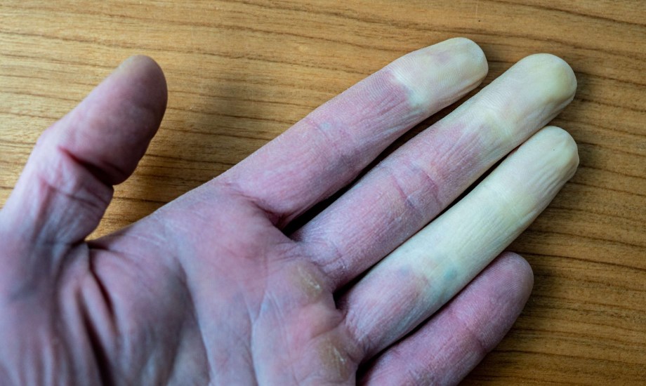 نصائح للوقاية قضمة الصقيع