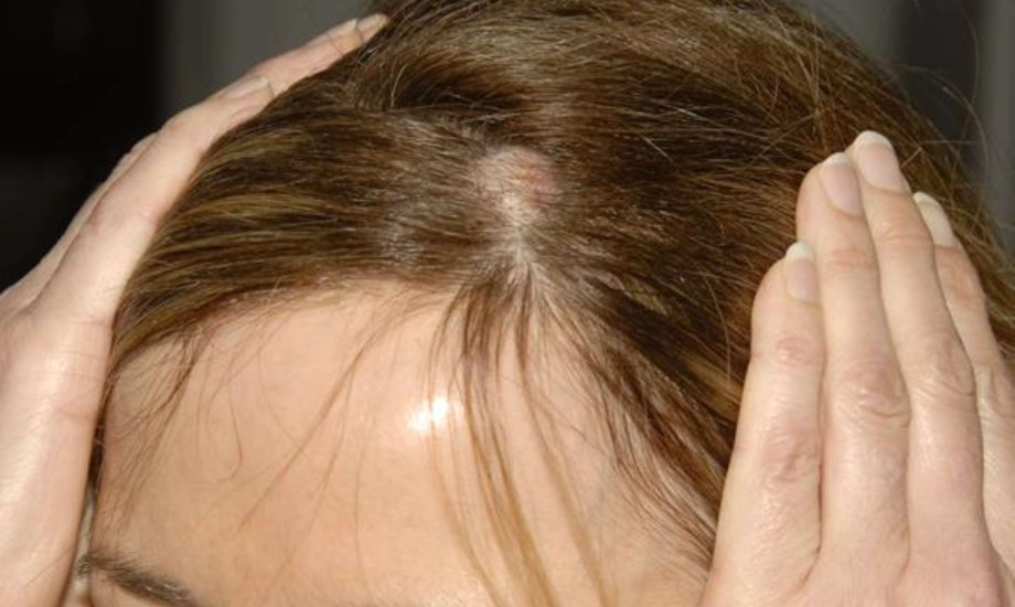 أسباب تكوين الكيس الشمعي وأعراضه