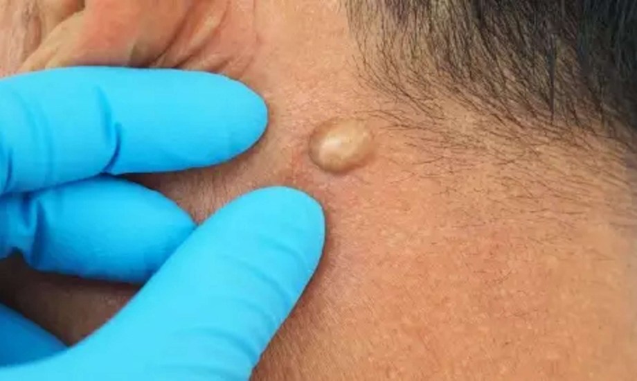 طرق علاج الكيس الشمعي