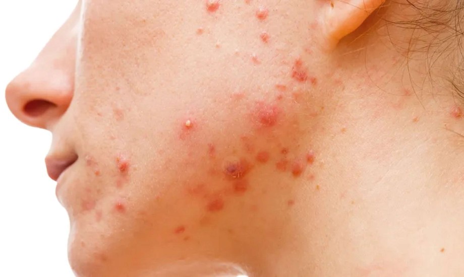 العلاقة بين النظام الغذائي وحب الشباب الكيسي