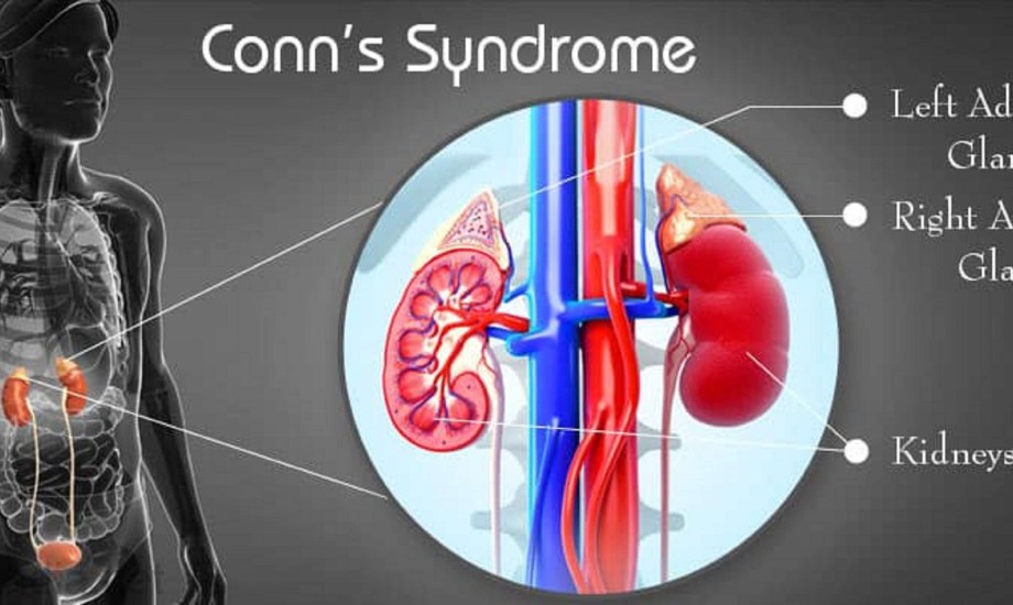 أسباب وأعراض متلازمة كون