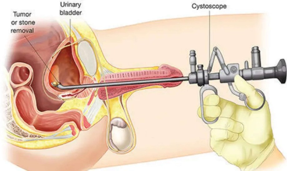 استئصال البروستاتا بالليزر الهولميوم