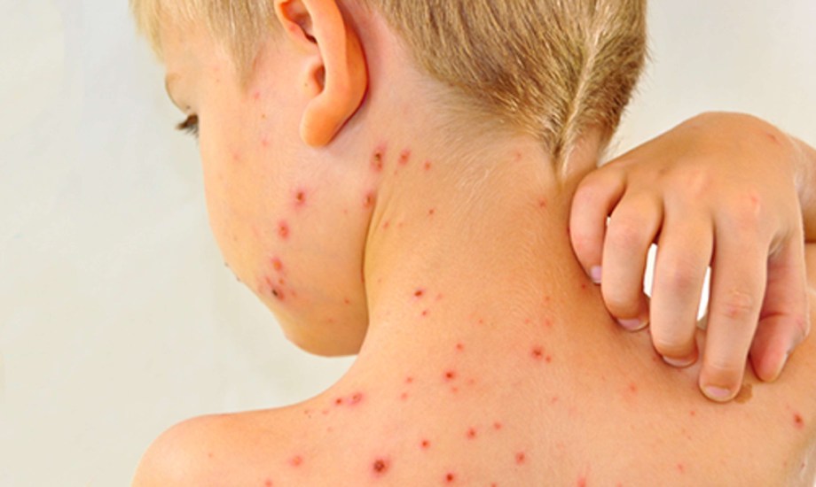 تفشي الحصبة في الولايات المتحدة