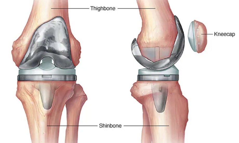 بدائل استبدال الركبة