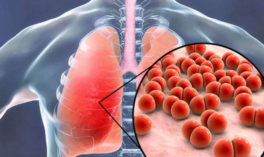 اليوم العالمي للسل