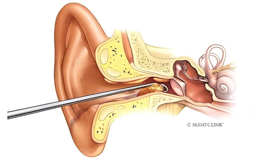 طريقة إزالة شمع الأذن