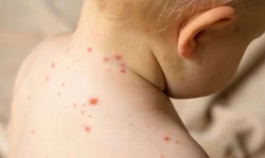 الآثار طويلة المدى للحصبة عند الأطفال