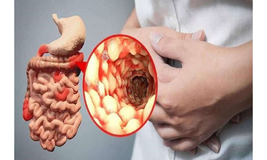 أول علاج منزلي لمرض كرون