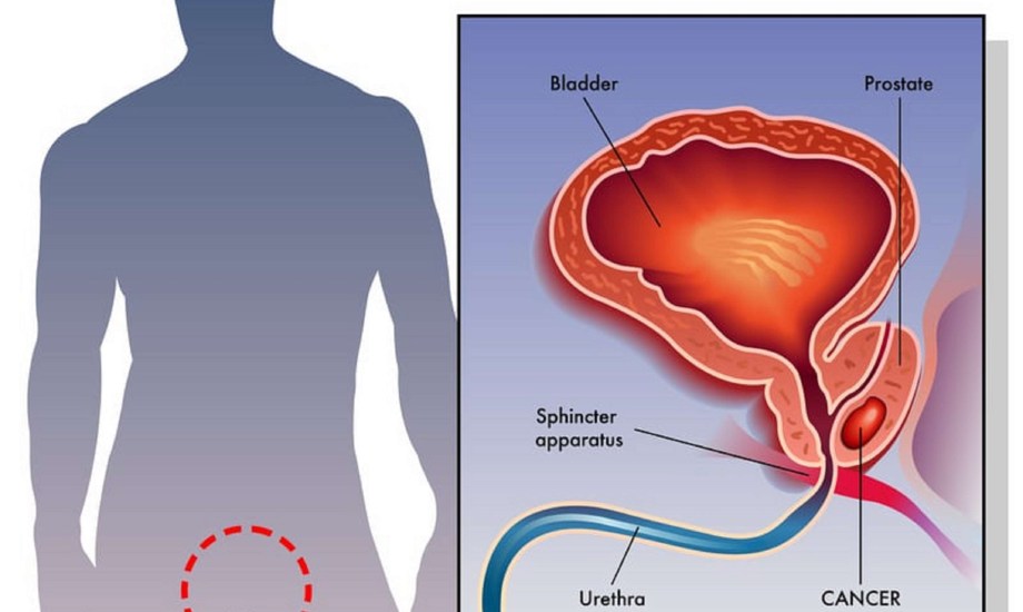 هل يمكن أن يسبب سرطان البروستاتا ضعف الانتصاب؟