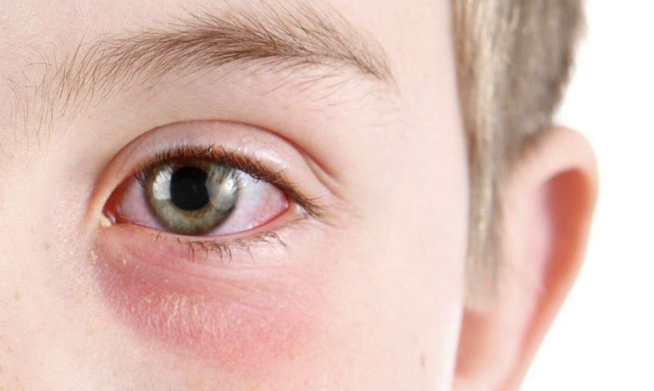 هل التهاب الملتحمة عند الأطفال مُعدٍ؟