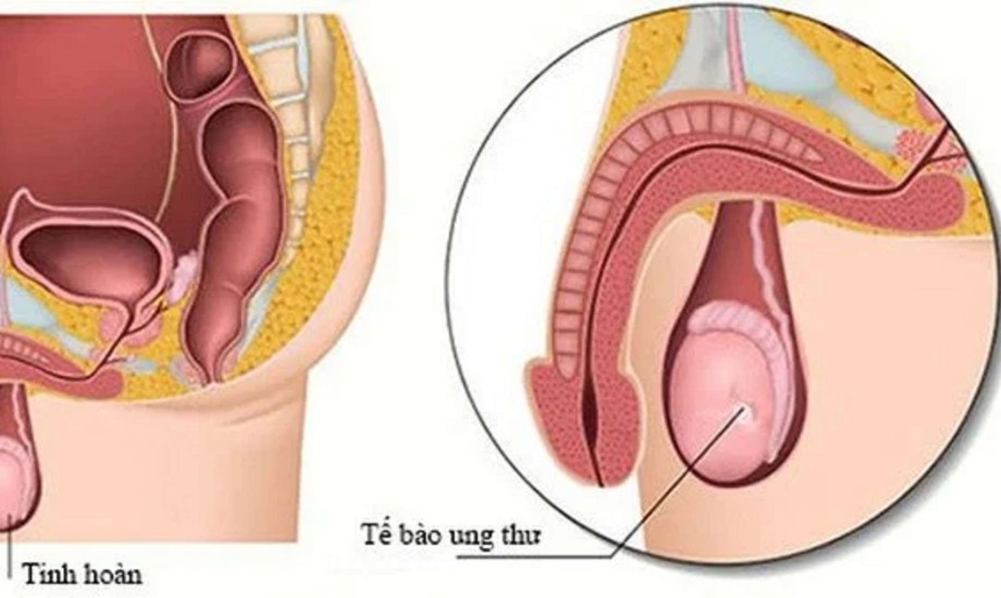 طرق تشخيص سرطان الخصية