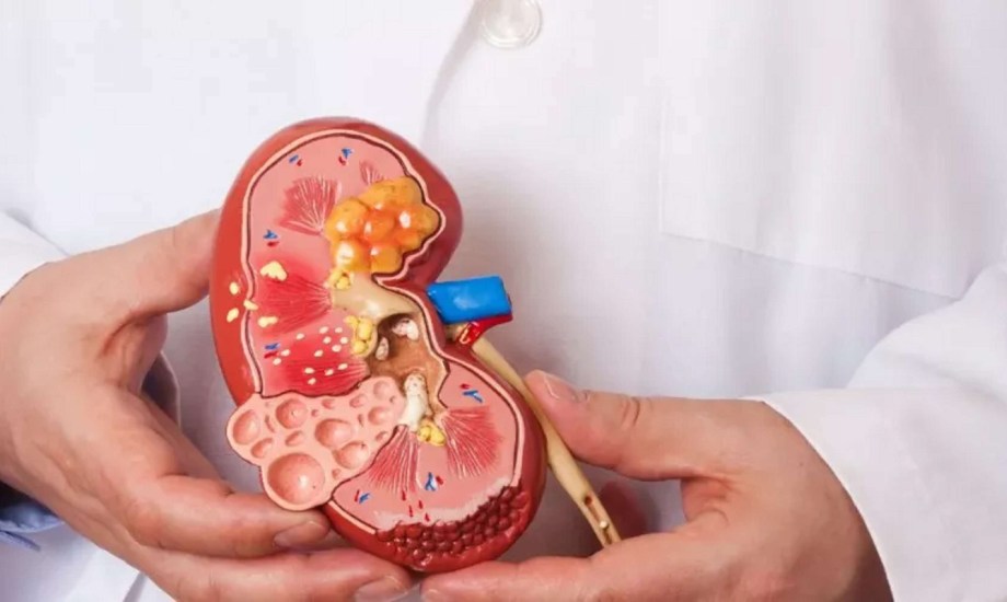  أعراض وطرق الوقاية من مرض الكُلى المزمن