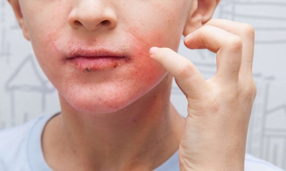 أسباب وأعراض ونصائح للوقاية من مرض القوباء