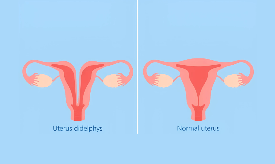 الرحم المزدوج.. أسبابه وأعراضه وتأثيره على الحمل