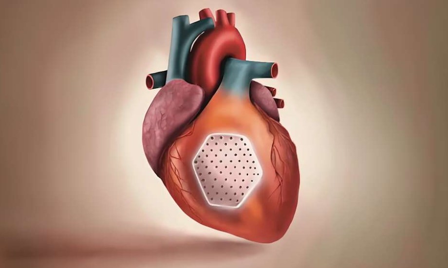 الرقعة القلبية أمل جديد لإنقاذ المرضى