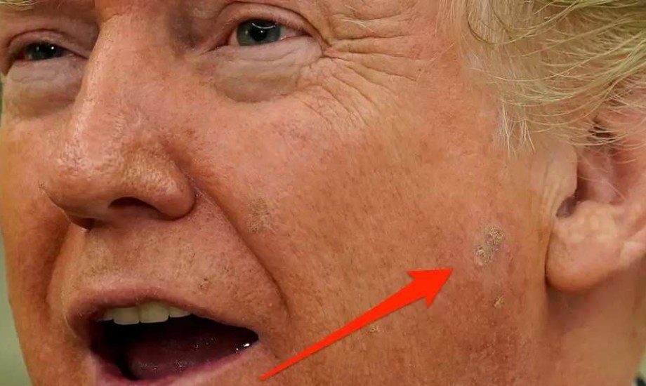 ما هو التقرن السفعي الذي ظهر عند ترامب؟