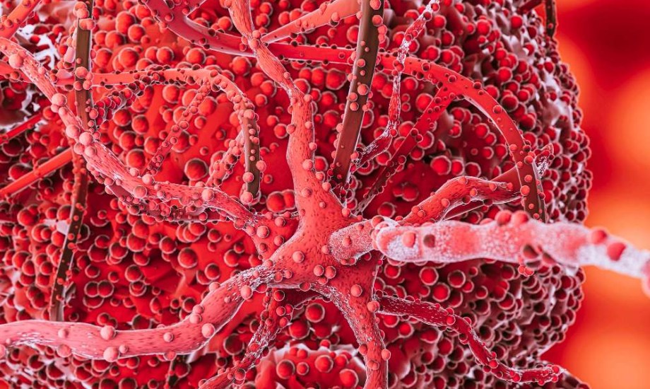 انسداد الشريان السباتي يسبب السكتة الدماغية