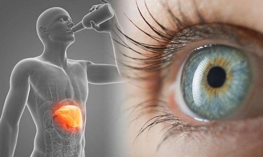 5 علامات في العين تنذر بأمراض الكبد