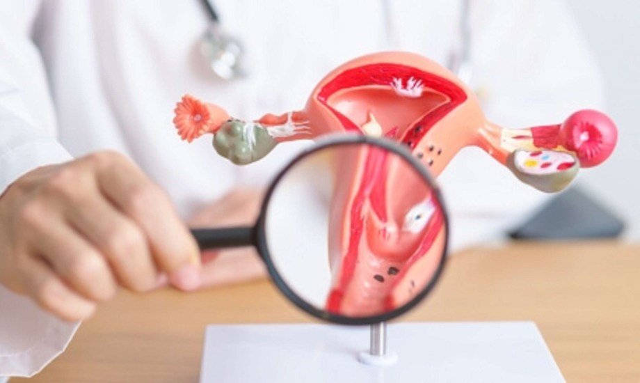 3 نصائح للوقاية من الإصابة ببطانة الرحم المهاجرة