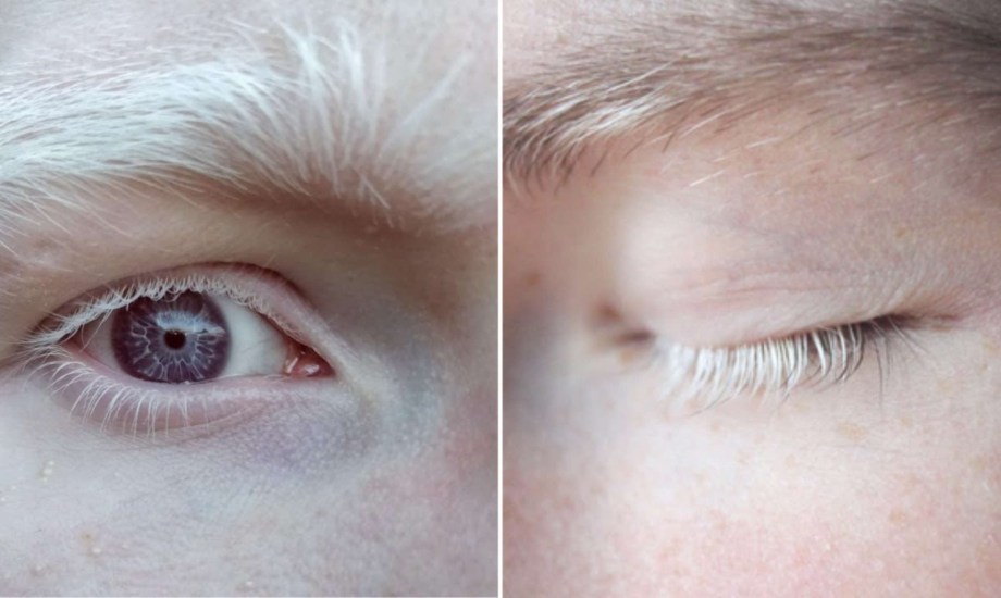 أسباب شيب الرموش