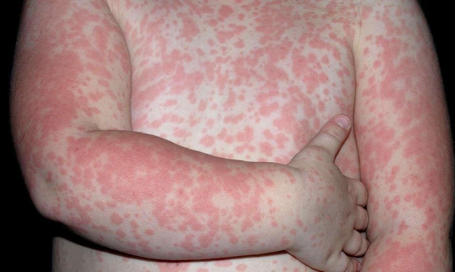 8 حالات جلدية تسبب بقعا حمراء