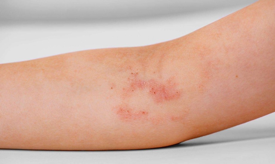 علاج جديد للإكزيما